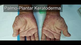 Palmoplantar Keratoderma [upl. by Adiaros]