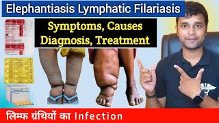 Elephantiasis  Filariasis  Symptoms Causes Diagnosis Treatment Prevention In Hindi [upl. by Colly]