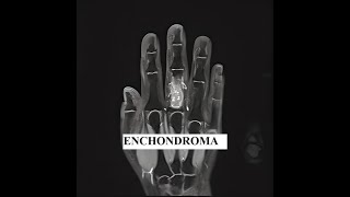 Enchondroma Tumor What You Need To Know [upl. by Ennair]