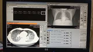 Mild Centrilobular emphysema  emphysema  hrct chest  cough 😷  shortness of breath 🫁 [upl. by Stilla731]