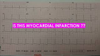 EMERY PHENOMENON I PSEUDO STEMI [upl. by Riocard]