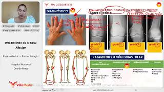 OSTEOARTRITIS  REUMATOLOGÍA  VILLAMEDIC [upl. by Ahsilahk]