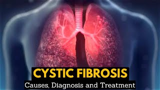 CYSTIC FIBROSIS Causes Signs and Symptoms Diagnosis and Treatment [upl. by Epuladaugairam]