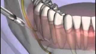 Malameds Local Anesthesia 11 Supplemental Injection Techniques [upl. by Tulley]