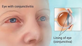 Conjunctivitis  Ophthalmology Videos [upl. by Nalod]