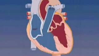 Tetralogy of Fallot [upl. by Philemol]