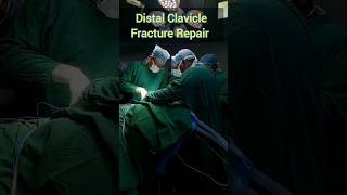 Distal Clavicle Fracture Repair claviclefracture [upl. by Sakul]