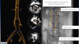 Visions PV 035 Digital IVUS Catheter Animation [upl. by Ahsimrac275]