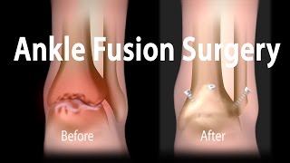 Ankle Fusion Surgery Animation [upl. by Brandt401]