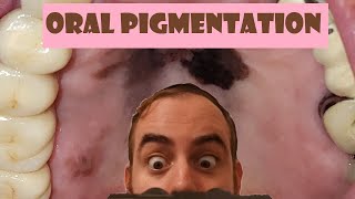 The ULTIMATE Pigmented Oral Lesion Review Video [upl. by Albers]