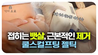 접히는 뱃살 근본적인 제거를 원한다면 쿨스컬프팅 젤틱 [upl. by Azilem]