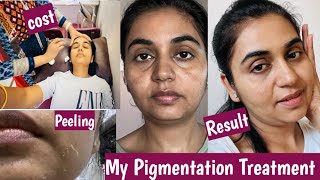 My Pigmentation Treatment  Yellow Peeling for dark spots pigmentation darkspots treatment [upl. by Schott]