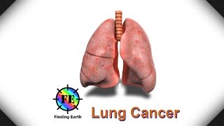 Lung Cancer  Symptom Causes amp Diagnosis Finding Earth [upl. by Alarise]