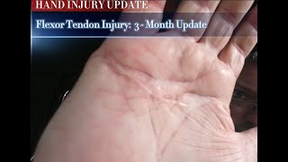 Flexor Tendon injury 3Month Update After Surgery [upl. by Eserahs]