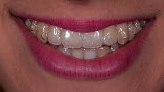 Invisalign Caso Clinico con grave affollamento [upl. by Ike]