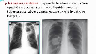 Syndromes parenchymateux  Quatrième Année Médecine [upl. by Zoller969]