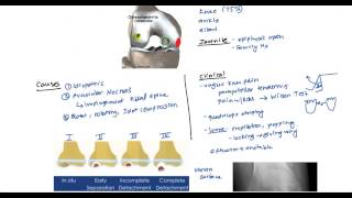 Osteochondritis and Osgood Schlatter for the USMLE [upl. by Padget]