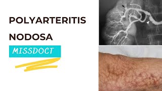 Poly Arteritis Nodosa [upl. by Oech225]