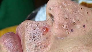 Big Cystic Acne Blackheads Extraction Blackheads amp Milia Whiteheads Removal Pimple Popping  313 [upl. by Hibben756]