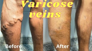 Laser treatment of varicose veins  Varicose veins treatment in Ranchi  Varicose vein after 7 days [upl. by Armond]