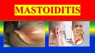 MASTOIDITIS  define  classification  pathophysiology  clinical  diagnostic  management [upl. by Airehc90]