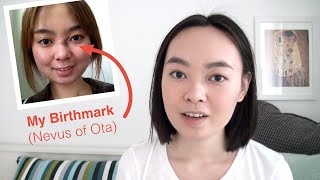 I Had a Birthmark on My Face  4 Years After Removal Nevus of Ota [upl. by Eleira982]