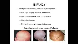 Neurology Hydrocephalus part 2 [upl. by Enayd]