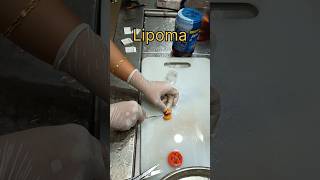 Lipoma soft tissue tumour [upl. by Lertram180]