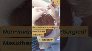 Mesotherapy  NonInvasive amp NonSurgical Hair Loss treatment at SkinQure [upl. by Mariele]