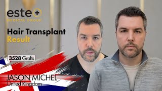 Turkey Hair Transplant Result 3528 Grafts hairtransplantturkey hairtransplantbeforeafter [upl. by Nitsirk]