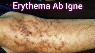 Erythema Ab Igne in Women [upl. by Youlton]