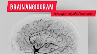 Brain Angiogram DSA Aneurisam Stroke [upl. by Sillert]