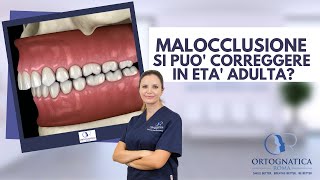 Malocclusioni dentoscheletriche è possibile correggerle in età adulta [upl. by Bart]