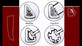 Chronic osteomyelitis [upl. by Annailuj]