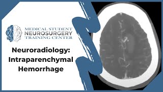 Neuroradiology Intraparenchymal Hemorrhage [upl. by Khai833]