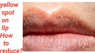 yellow spot on lip what to doFordyces granules in buccal mucosa or lip is it seriously required tt [upl. by Tressia]