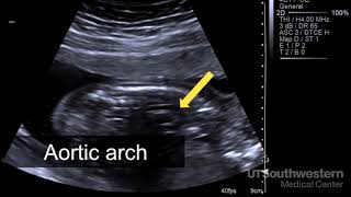 Understanding your fetal ultrasound [upl. by Akema]