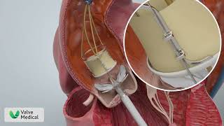 Valve Medicals Aortic Valve Replacement Animation [upl. by Reham853]