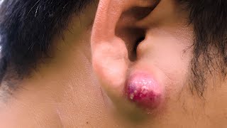 Ear Abscess [upl. by Asus279]