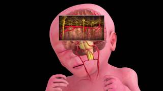 Periventricular Leukomalacia Explained by a Lawyer [upl. by Marylin]