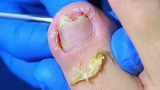 Trimming Removing Dead Skin and Huge Ingrown Toenails [upl. by Muriah]