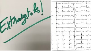 Extrasystoles ablation pour tous [upl. by Aleunam490]