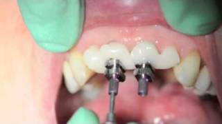 Customised impression bridge from Byrnes Dental and David Furze [upl. by Enohpets]