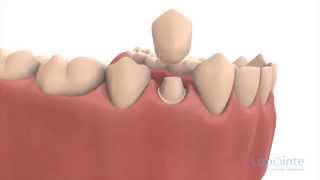 Reconstitution en prévision d’une couronne  Centres dentaires Lapointe [upl. by Aveneg]