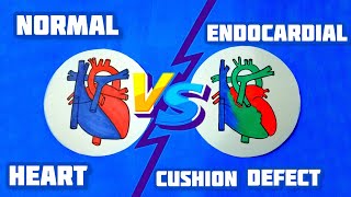 Endocardial Cushion Defect or Atrioventricular Canal Defect  Congenital Heart Disease  Dr Deen [upl. by Brandy181]