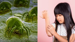 How To Get Rid of Scabies  Causes amp Remedies [upl. by Orsino]