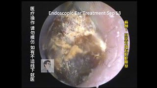 The difference between directly removing cerumen and removing it after softening 20230918 [upl. by Uwton]