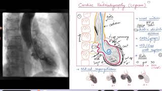 Cardiac Ventriculography Left Ventriculogram [upl. by Rasla]