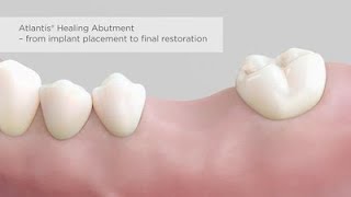 Atlantis Healing Abutment  from implant placement to final restorationsubtitles [upl. by Delphinia]