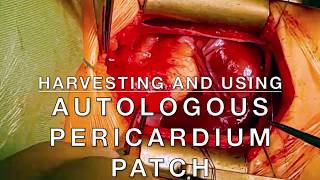 Harvesting and using glutaraldehydetreated autologous pericardium patch [upl. by Anatola]